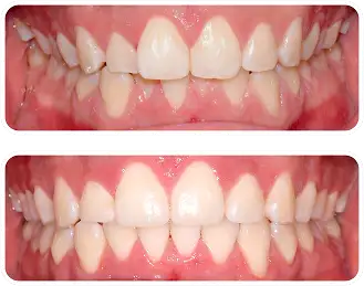 過蓋咬合(ディープバイト)