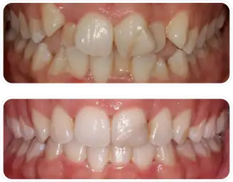 重度の叢生/抜歯症例