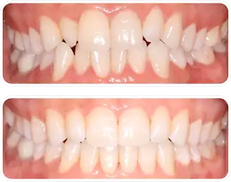 中等度の叢生の一例