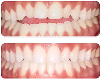 オープンバイト(開咬)の一例