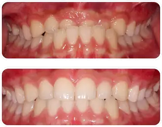 交叉咬合(クロスバイト)